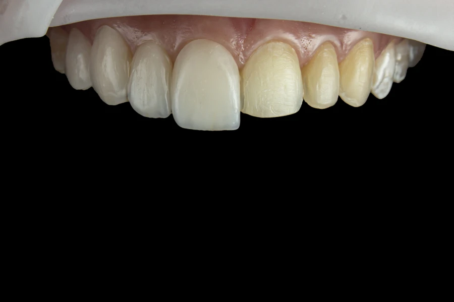 veneers-chillicothe-il-dental-veneer-shade-comparison