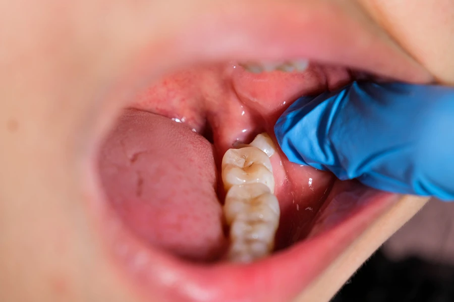wisdom-teeth-removal-peoria-il-post-extraction-healing-site