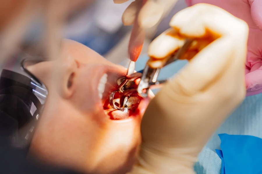 wisdom-teeth-removal-peoria-il-wisdom-tooth-extraction-procedure