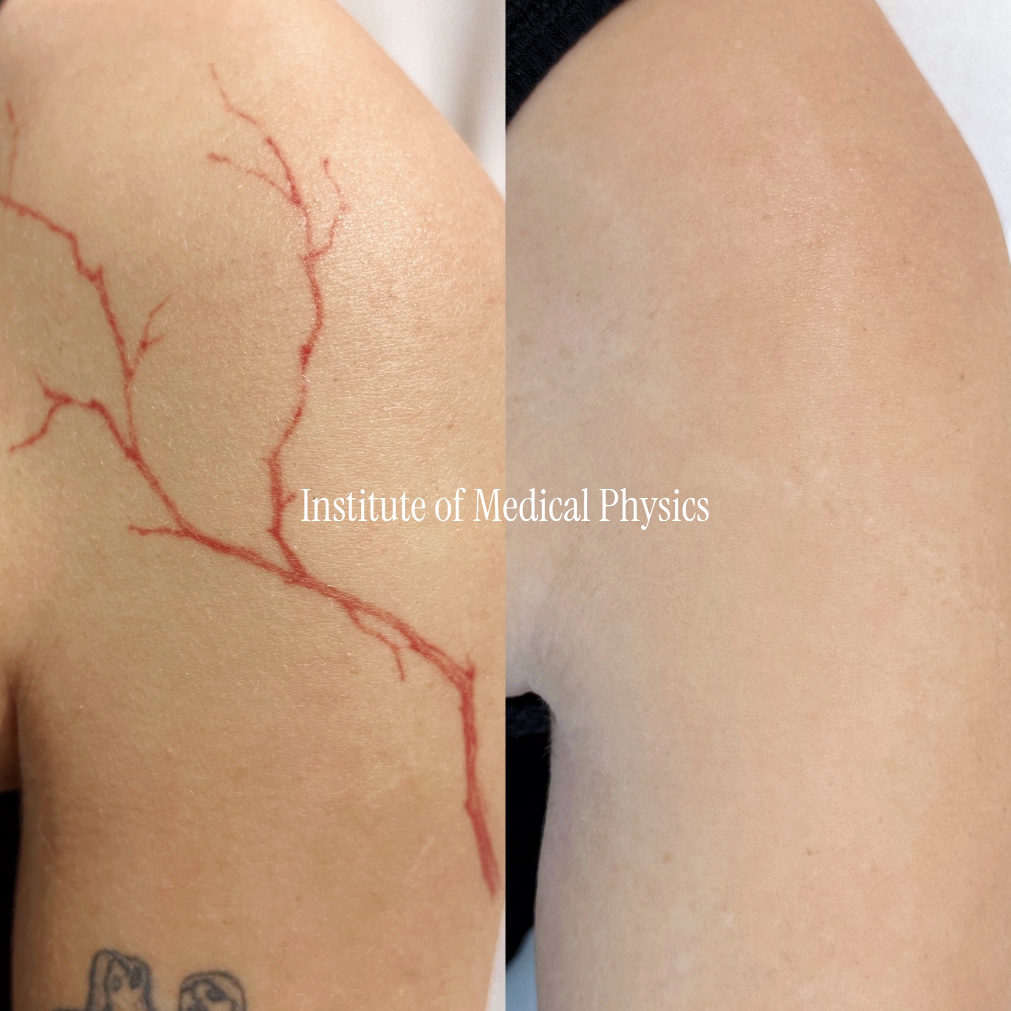 Fine-line pure red ink, sprawling branch design across the deltoid. Gone in 5 months. Red is one of the hardest pigments to clear and needs precise 532nm targeting — a wavelength many commercial platforms lack. Phantom™ 532nm delivered complete clearance with no residual pigment and no textural change. Fitzpatrick II.
