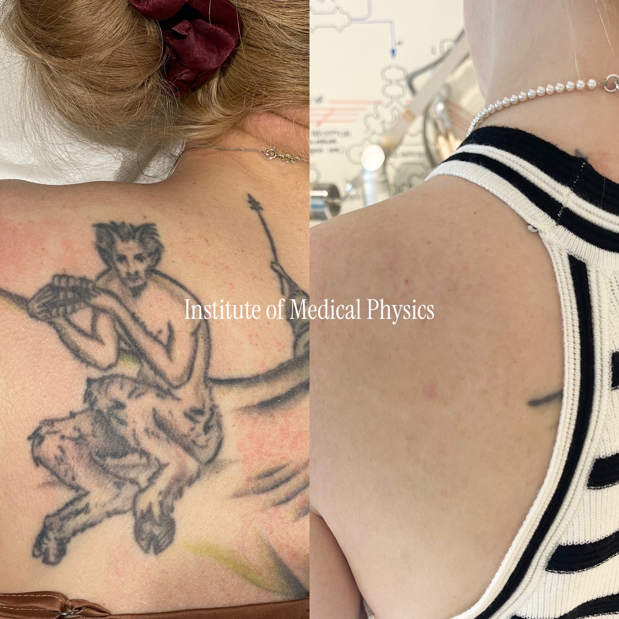 Mythological figure, upper back. Large black-and-grey centaur/satyr piece with faint green-yellow accents. Gone in 8 months. Broad black-grey coverage with sparse warm tones needs more than one wavelength — Phantom™ 1064nm cleared the dense black mass, 532nm lifted the residual green-yellow that resists single-platform systems. Complete clearance, skin texture preserved. Fitzpatrick II.