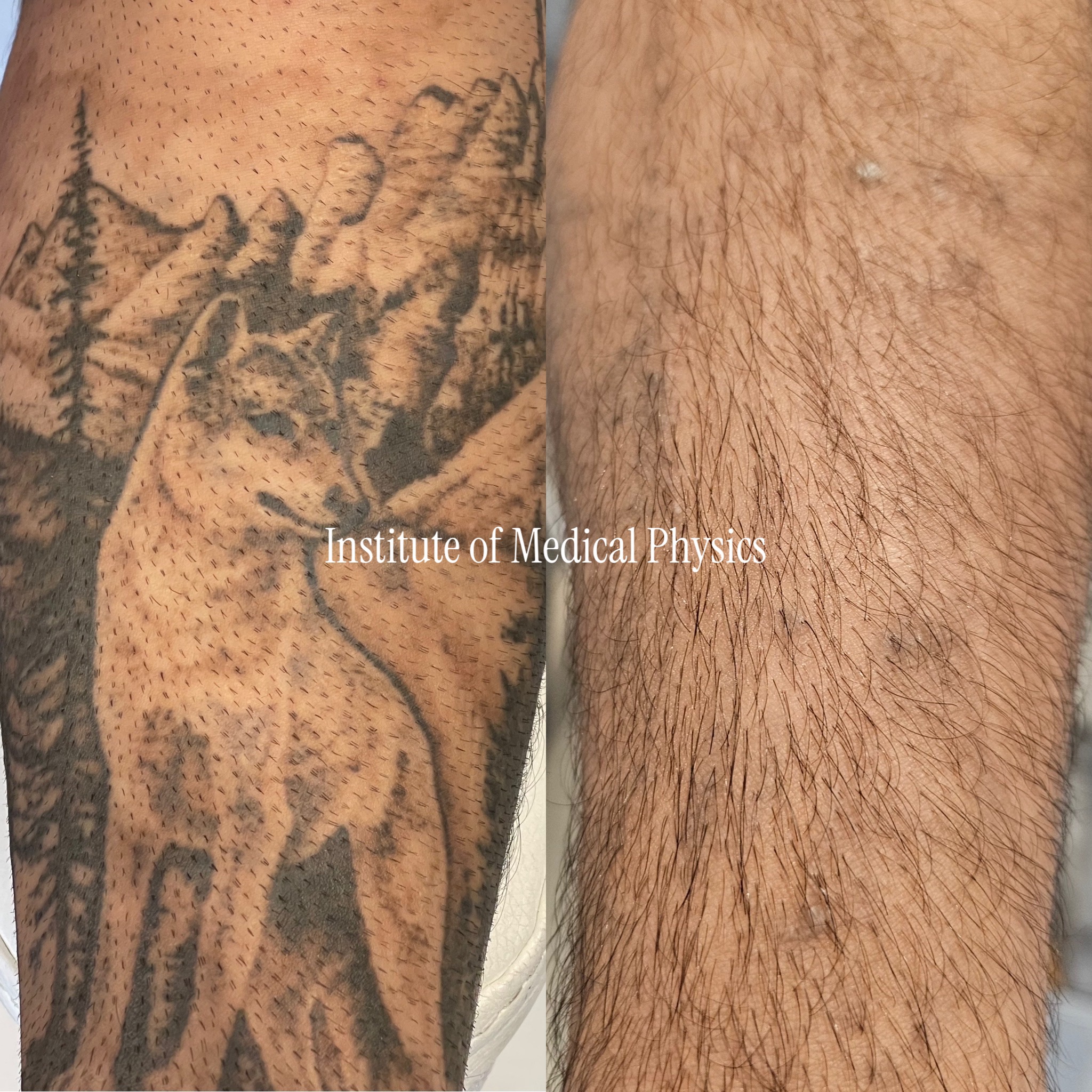 Dense black-and-grey wildlife piece with heavy saturated blackwork on warm mid-tone skin. Gone in 9 months. Solid black blocks on Fitzpatrick IV carry real burn and pigment-loss risk — Phantom™ 1064nm is the safest wavelength for dark skin and cleared the dense mass without disturbing surrounding tone. Specialist case: heavy black saturation on darker skin. Complete clearance, even tone preserved. Fitzpatrick IV.