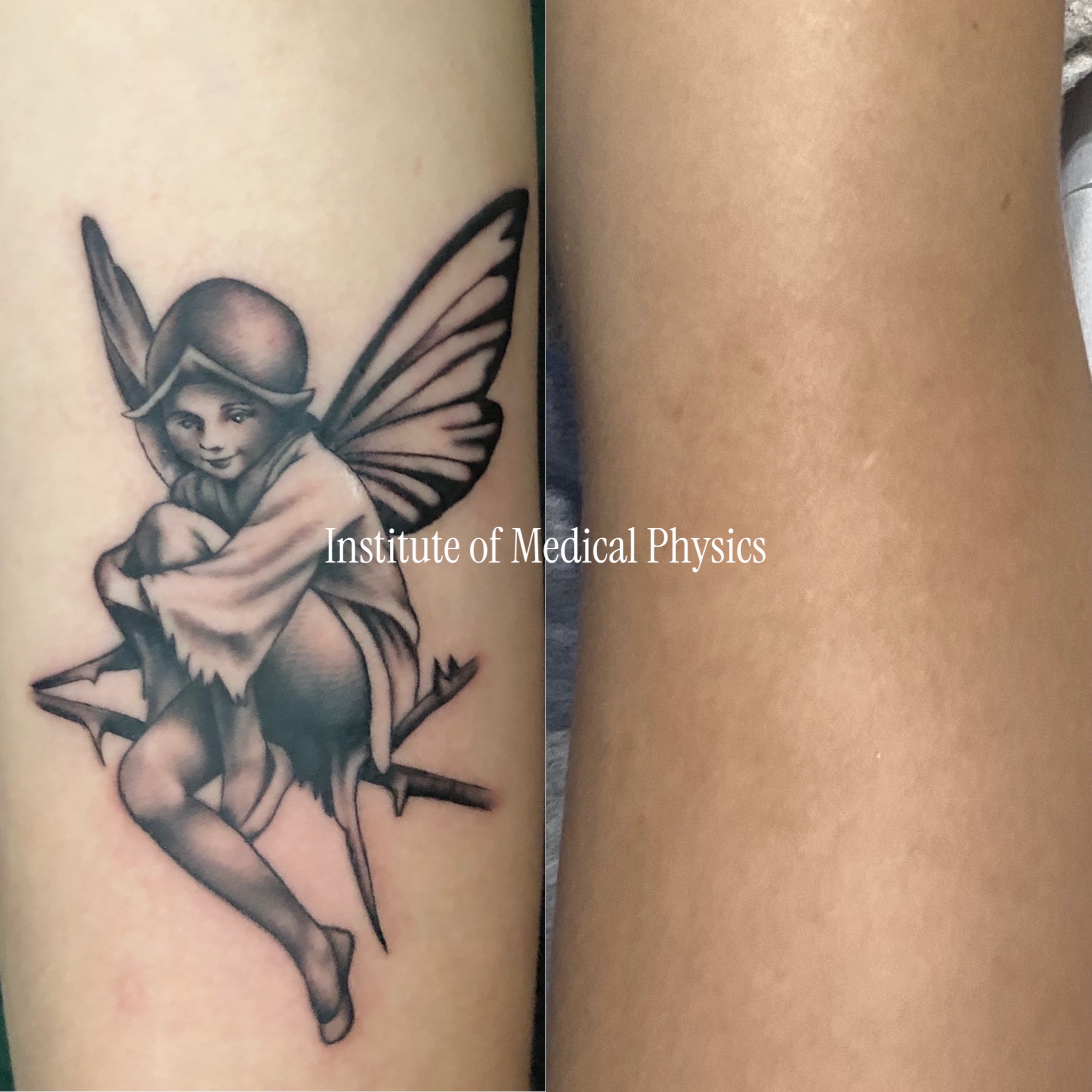 Detailed black-and-grey fairy with dense outlines and graded shading on light skin. Gone in 6 months. Pieces that mix solid black linework with soft tonal shading need two pulse profiles — Phantom™ 1064nm carried the dense outlines, Sub-300ps (280ps) cleared the smooth grey gradients lower-resolution lasers leave mottled. Complete clearance, texture preserved. Fitzpatrick II–III.