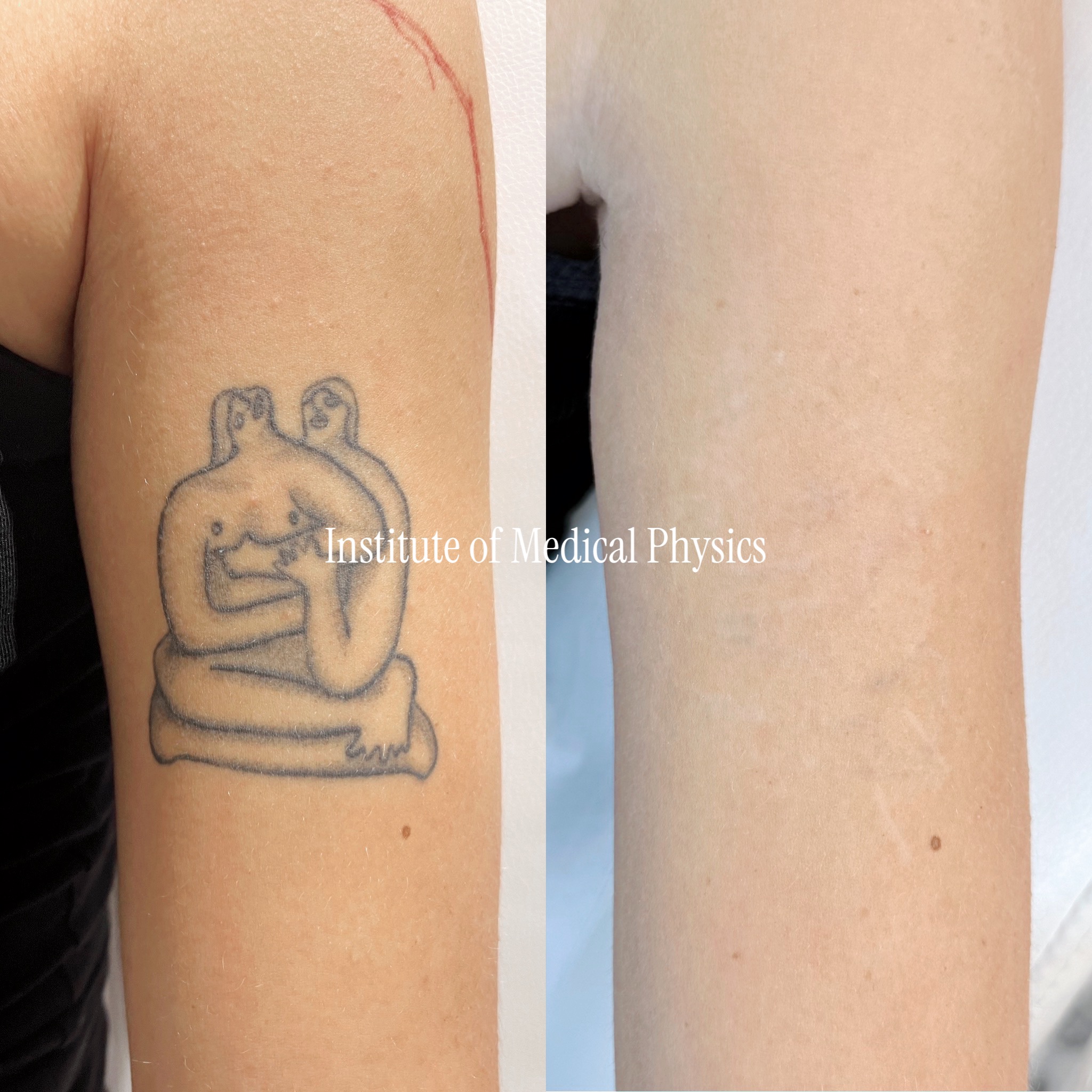 Fine-line black and grey with soft shading. Gone in 5 months. Grey wash disperses ink thinly, which stalls most clearances — Phantom™ 1064nm cleared the black linework, Sub-300ps (280ps) fractured the dilute grey-shade particles. Near-complete clearance, skin texture fully preserved. Fitzpatrick II.