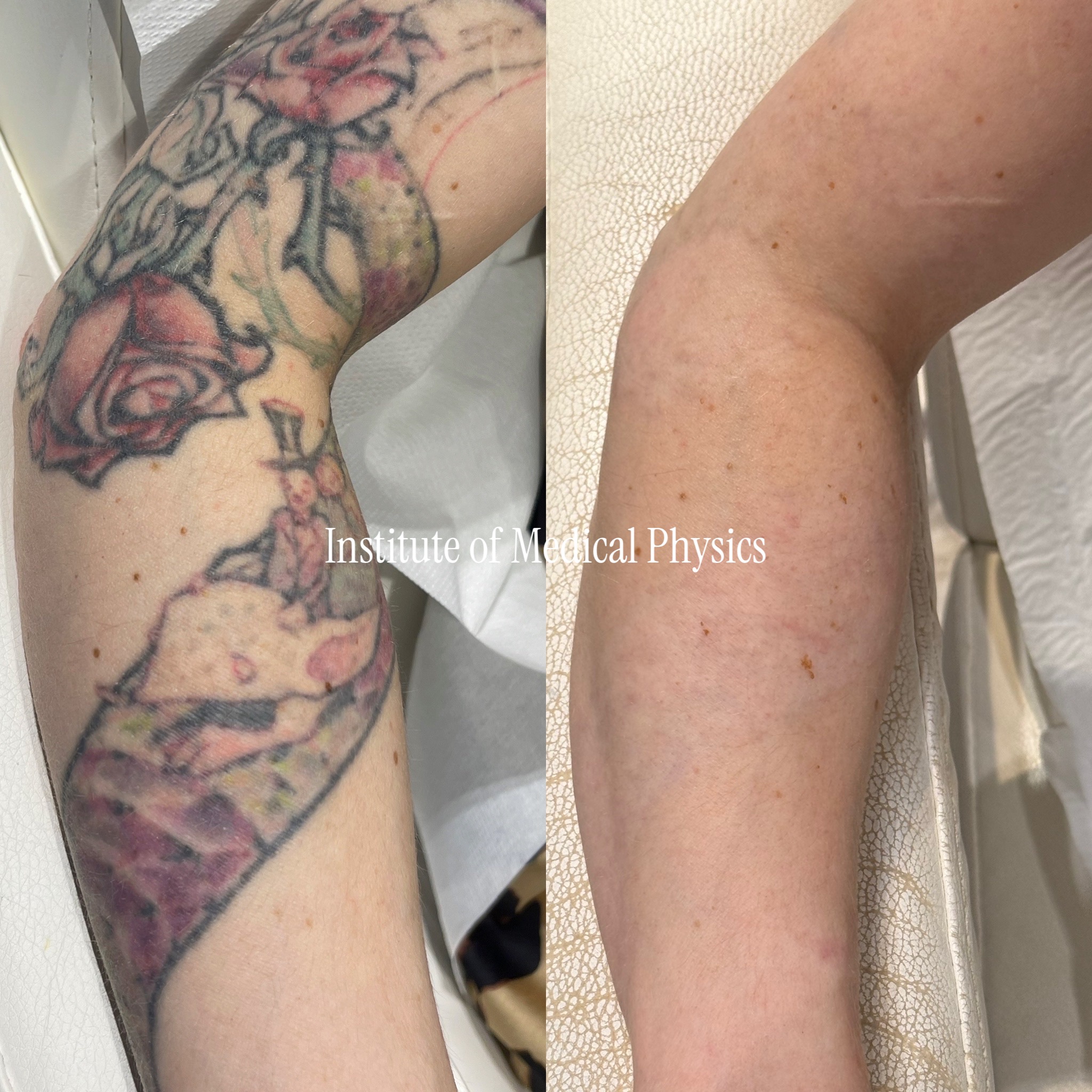 Large multi-colour roses — red, pink, green, purple, with black linework wrapping the full arm. Gone in 11 months. Full-colour coverage is the hardest removal there is, demanding the complete wavelength range — Phantom™ 532nm cleared the reds and pinks, 694nm broke the resistant greens, 755nm lifted the purple-blues, 1064nm carried the black. Specialist case: large saturated multi-colour sleeve. Fitzpatrick II.