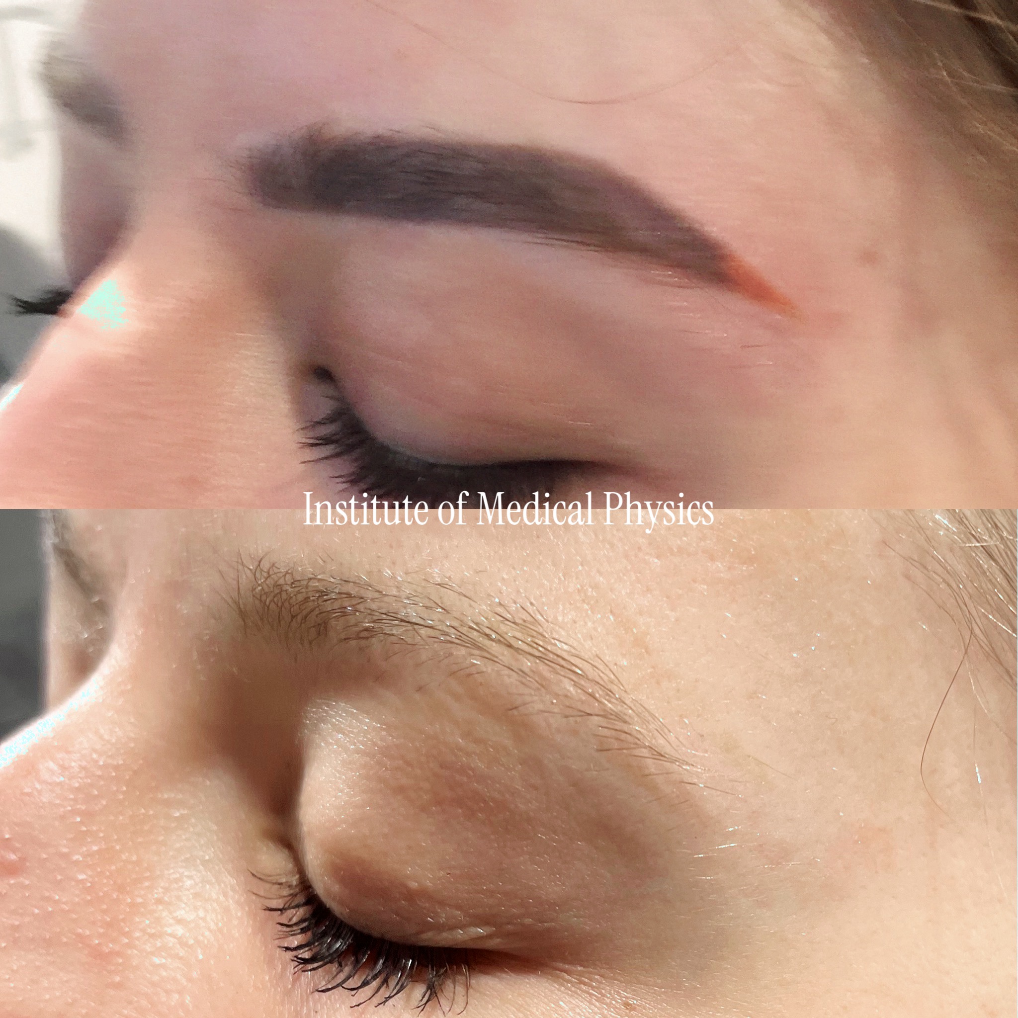 Saturated permanent makeup brow with dark base and orange/warm oxidised undertone. Gone in 5 months. Cosmetic brow pigment sits on the face beside the eye and can paradoxically darken if hit with the wrong wavelength — Phantom™ 1064nm cleared the dark base safely, 532nm targeted the exposed warm-orange tones that defeat single-wavelength systems. Specialist case: facial location plus cosmetic ink. Complete clearance, natural brow hair preserved. Fitzpatrick II.