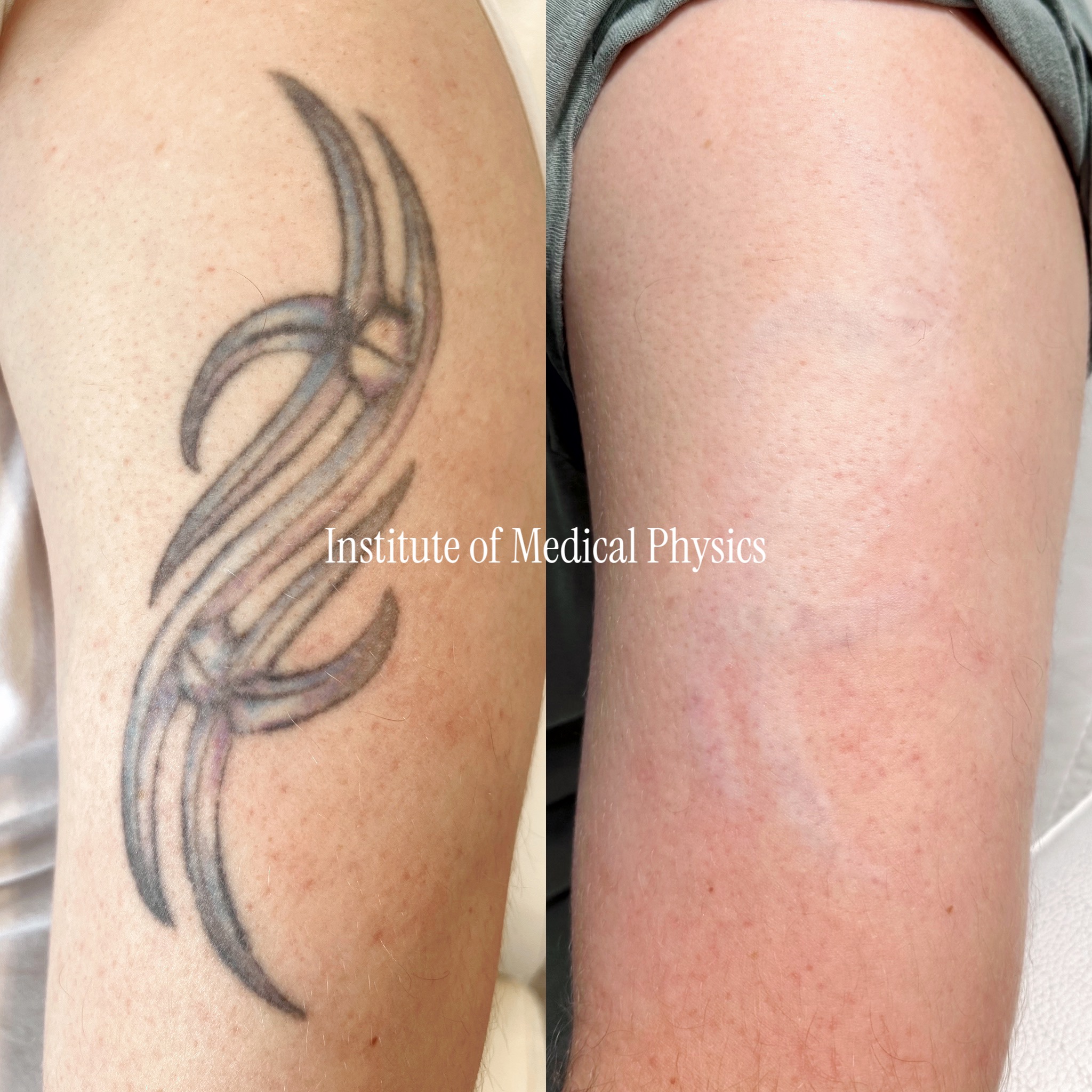 Aged black tribal piece, faded to blue-grey with a slight purple cast on freckled fair skin. Gone in 6 months. Old black ink that has shifted blue-grey needs more than a black protocol — Phantom™ 1064nm cleared the dark base, 755nm targeted the blue-shifted pigment that lower-spec lasers leave as a grey shadow. Complete clearance. Fitzpatrick II.