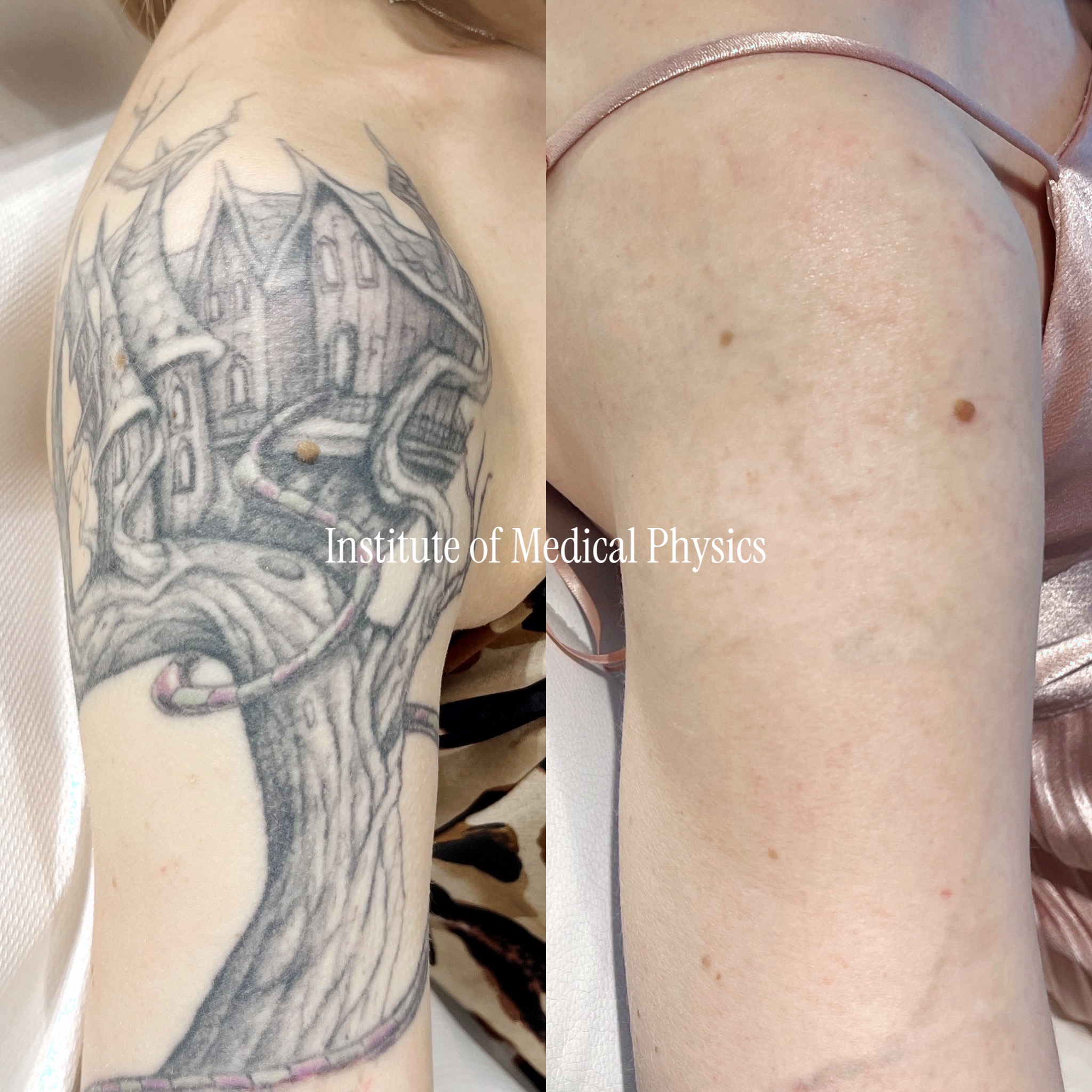 Large detailed black-and-grey castle half-sleeve with dense shading and faint pink/purple accents on fair skin. Gone in 10 months. Heavy grey-wash detail over a large area is deceptively hard — dilute shading stalls lower-resolution lasers — so Phantom™ 1064nm carried the dark linework, Sub-300ps (280ps) fractured the broad grey gradients, 532nm lifted the pink accents. Specialist case: large saturated coverage. Complete clearance, Fitzpatrick II.
