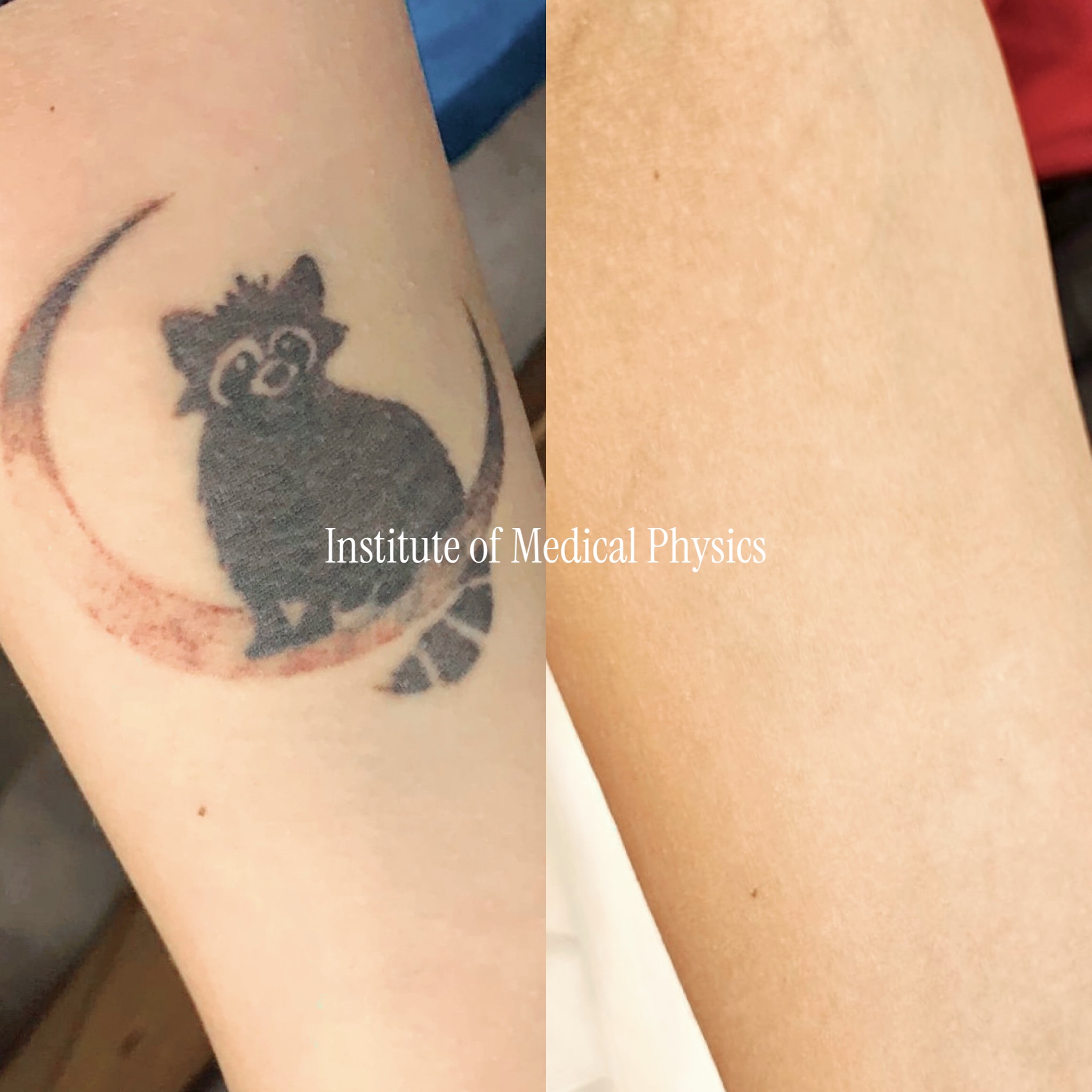 Solid black raccoon silhouette with a faded red/brown crescent on fair skin. Gone in 5 months. Dense solid black sits beside dilute warm-red ink — two very different targets — so Phantom™ 1064nm cleared the saturated black body, 532nm lifted the faded red crescent that single-wavelength black-only systems leave behind. Complete clearance, skin texture preserved. Fitzpatrick II.