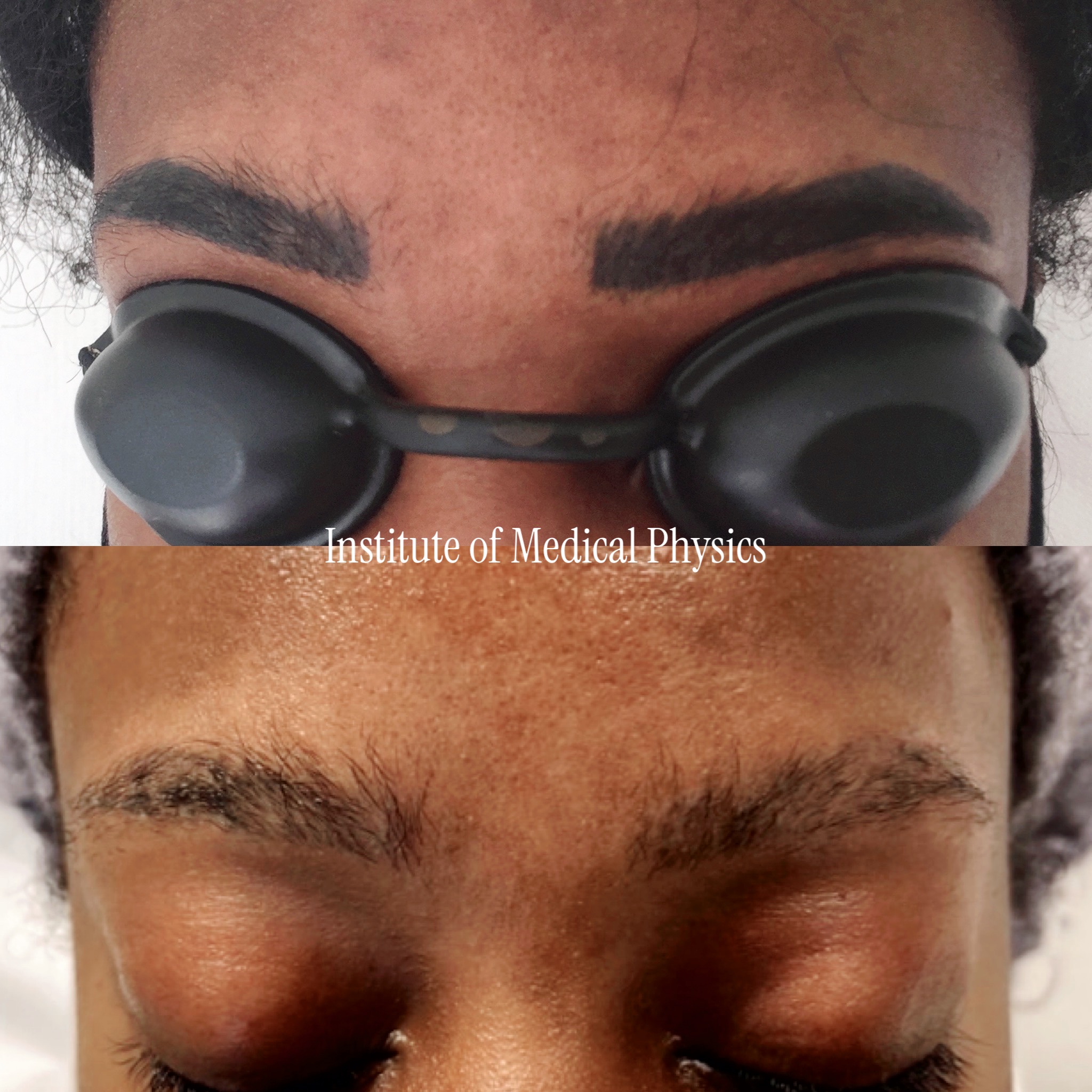Solid dark cosmetic brow pigment, heavily filled and squared, on deeply pigmented skin. Gone in 6 months. This is the highest-risk — dark cosmetic ink on dark skin, where the wrong wavelength burns or strips surrounding pigment. Phantom™ 1064nm cleared the pigment while protecting the surrounding skin. Specialist case: facial cosmetic ink on Fitzpatrick V–VI. Complete clearance, natural brow restored, no pigment loss. Fitzpatrick V–VI.