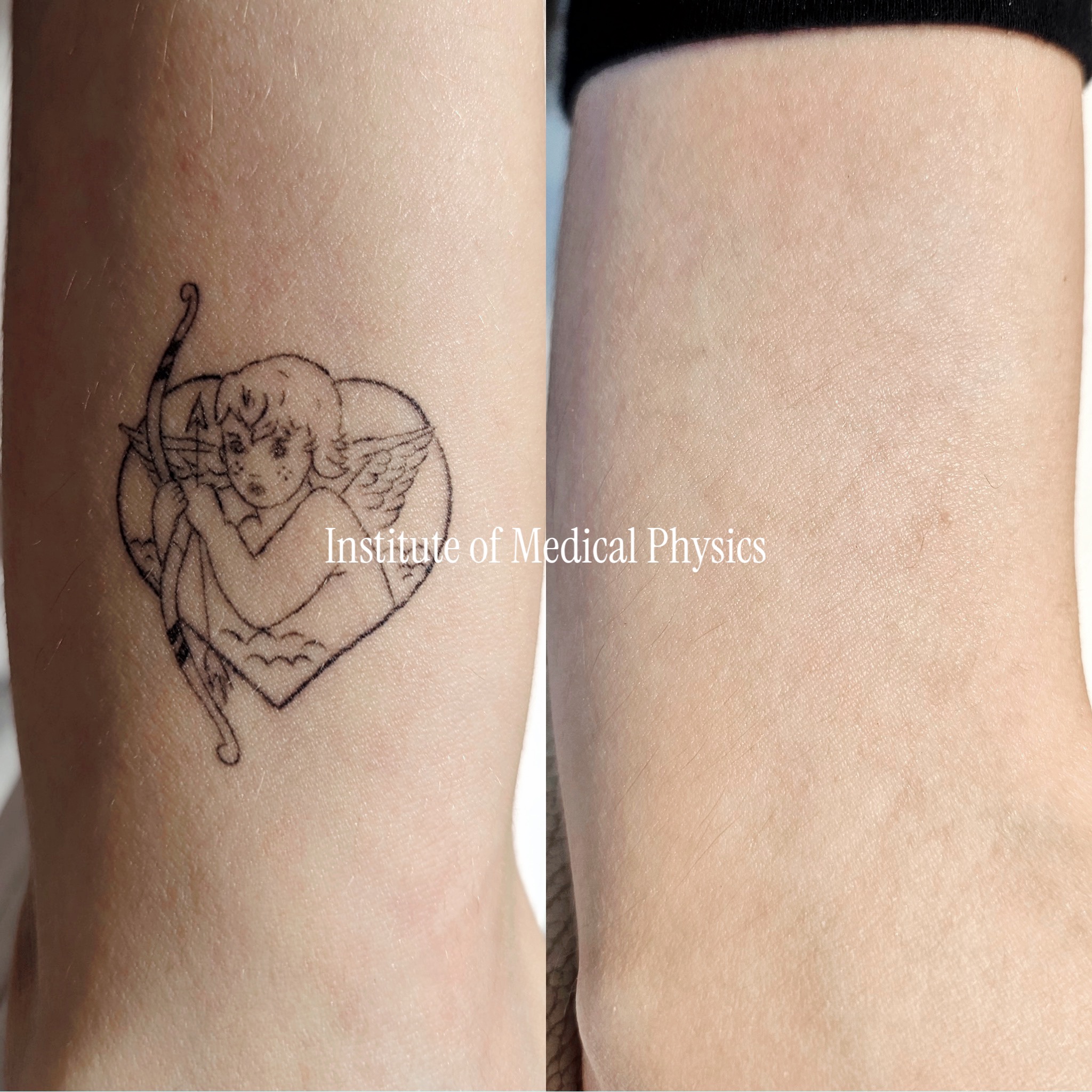 Delicate single-needle fine-line cherub with bow and heart, pure thin black outline on fair skin. Gone in 4 months. Fine-line work has so little pigment per line that lower-resolution lasers struggle to find a target without overtreating the surrounding skin — Phantom™ Sub-300ps (280ps) fractured the sparse black ink precisely with no collateral damage. Complete clearance, delicate skin texture preserved. Fitzpatrick II.