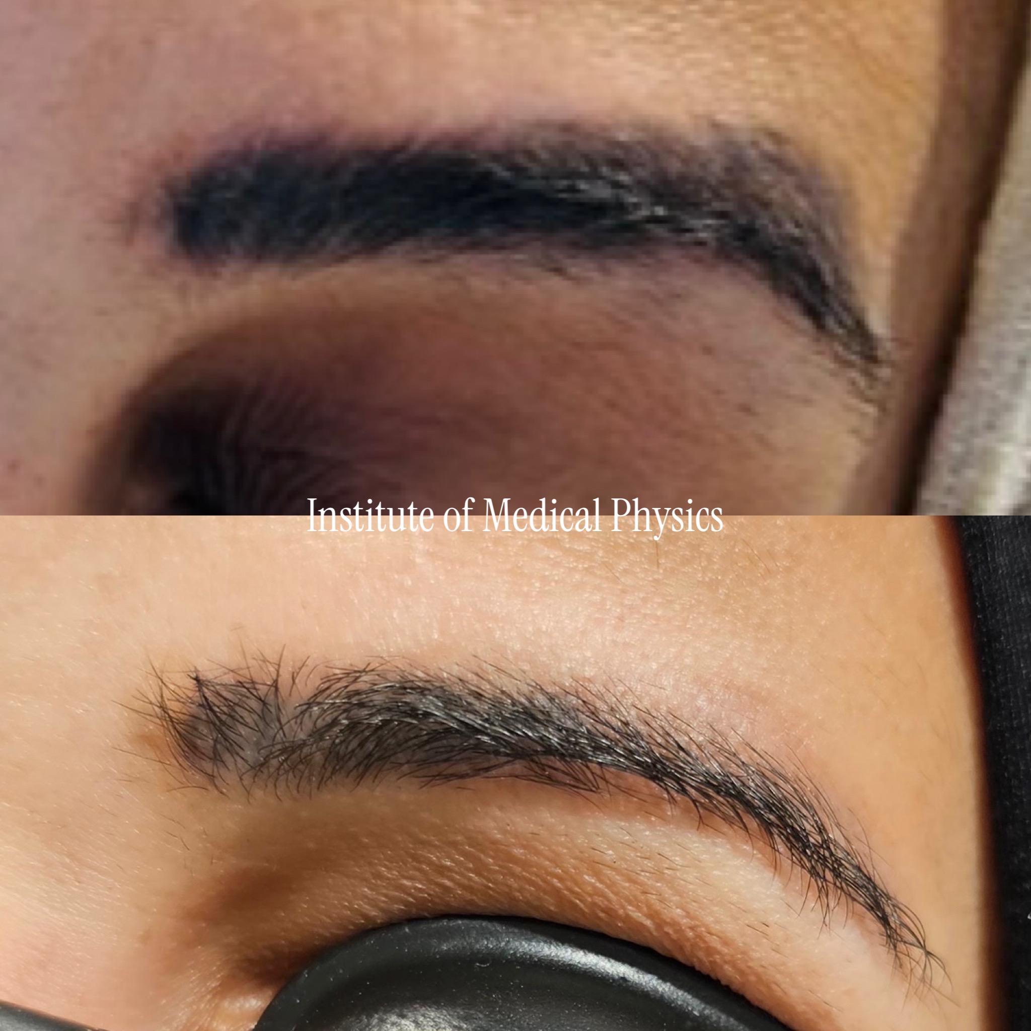 Dense block-filled cosmetic brow with a purple-blue oxidised cast on warm mid-tone skin. Gone in 5 months. Oxidised brow pigment on pigmented skin is a dual hazard. Phantom™ 1064nm cleared the dark base safely at this skin depth, 755nm targeted the blue-violet shift that defeats single-wavelength systems. Specialist case: facial cosmetic ink on Fitzpatrick IV. Complete clearance, natural brow hair preserved, no pigment loss. Fitzpatrick IV.