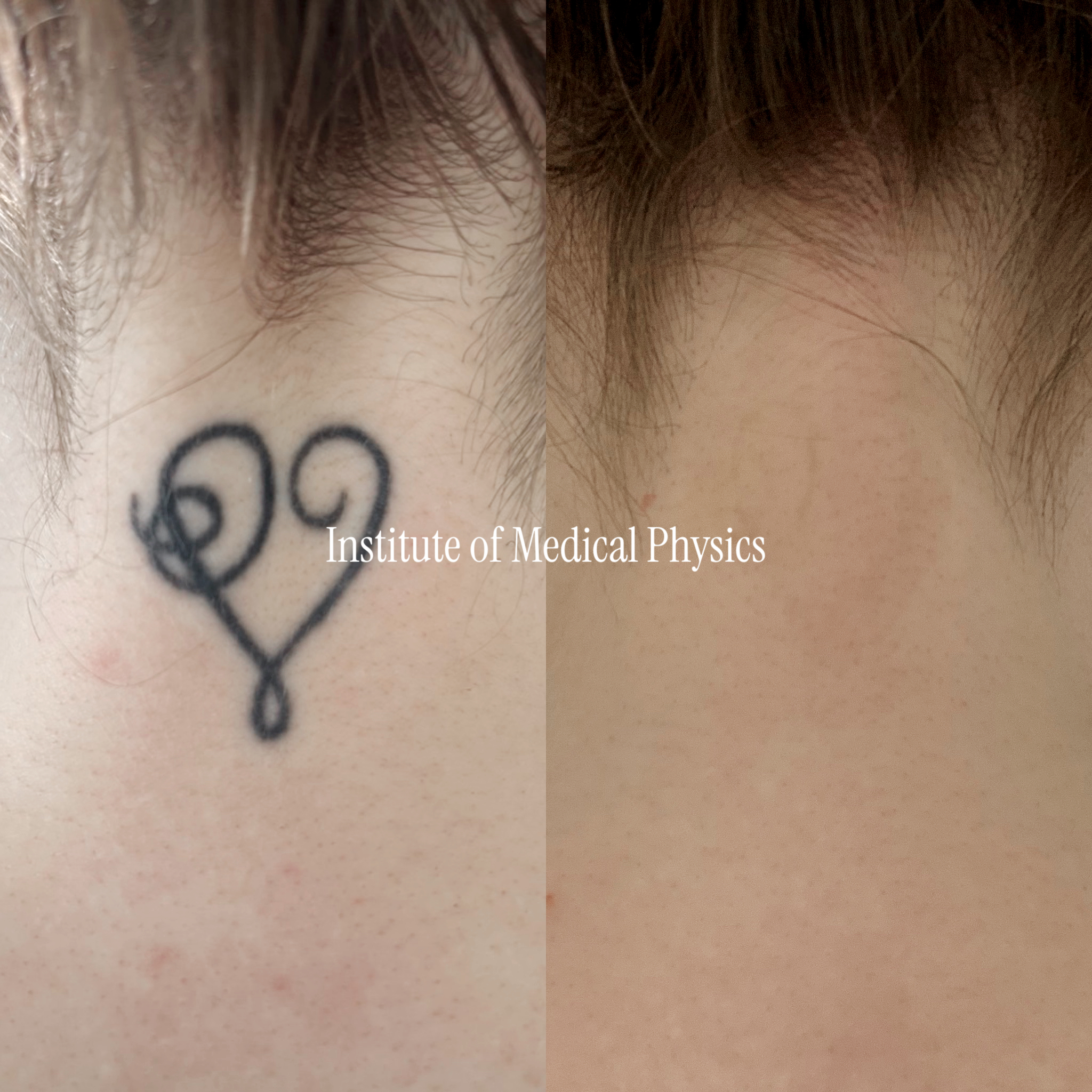 Bold solid black scrollwork heart, dense even linework on fair skin at the back of the neck. Gone in 5 months. Thick saturated black on the neck — where skin is thinner and closer to lymphatic drainage — needs a wavelength that clears densely without overheating delicate tissue, so Phantom™ 1064nm broke the solid black cleanly while biological therapy between sessions supported macrophage clearance. Complete clearance, skin texture preserved. Fitzpatrick II.