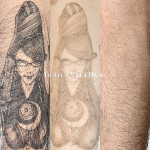 Full clearance on this dense black-and-grey illustrative piece — one of six tattoos removed from this patient's right arm. Fitzpatrick Type IV skin (Middle Eastern heritage) carries elevated risk for both post-inflammatory hyperpigmentation and hypopigmentation, especially with saturated black ink and fine linework like this. Phantom's multi-wavelength platform allowed the fluence and spot size to be matched precisely to the ink density and skin tone, protecting the surrounding melanin throughout treatment. Result: complete clearance, zero pigment disruption