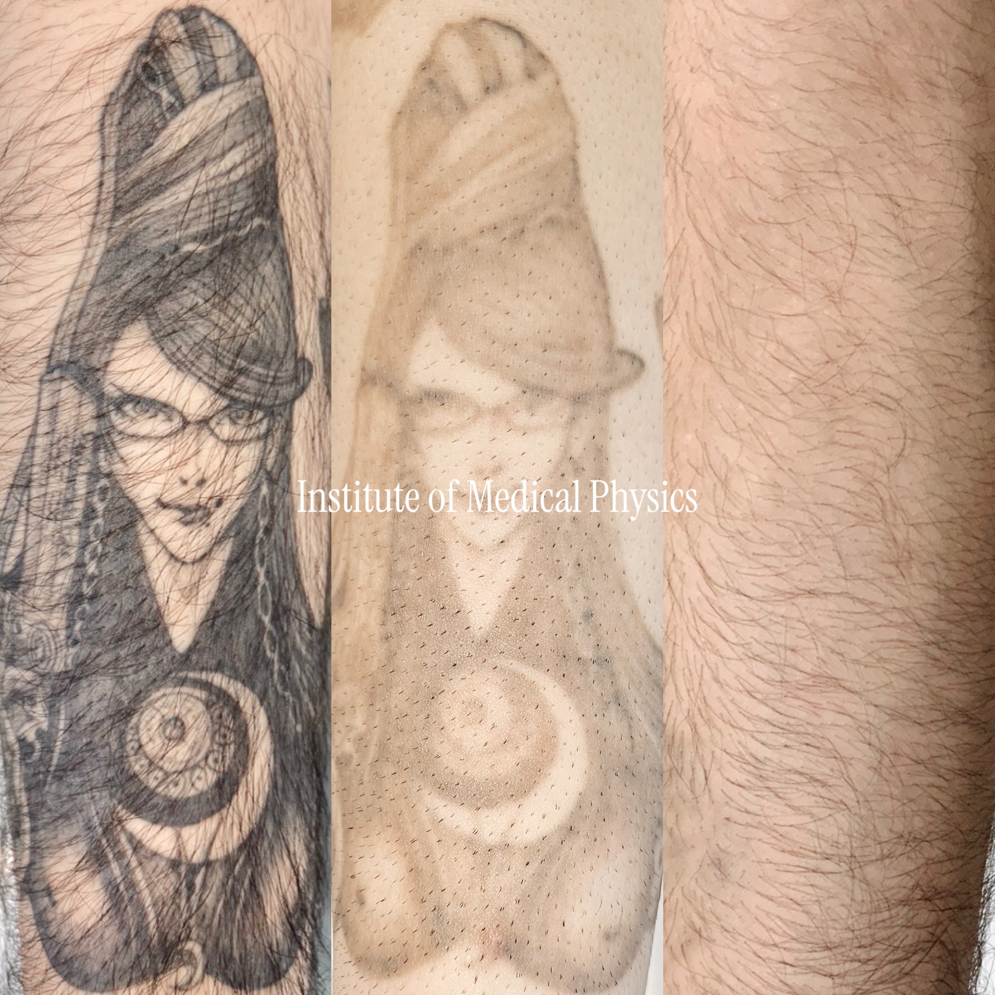 Full clearance on this dense black-and-grey illustrative piece — one of six tattoos removed from this patient's right arm. Fitzpatrick Type IV skin (Middle Eastern heritage) carries elevated risk for both post-inflammatory hyperpigmentation and hypopigmentation, especially with saturated black ink and fine linework like this. Phantom's multi-wavelength platform allowed the fluence and spot size to be matched precisely to the ink density and skin tone, protecting the surrounding melanin throughout treatment. Result: complete clearance, zero pigment disruption