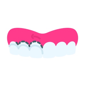 Gingivoplastie