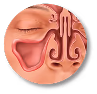 Balloon Sinuplasty Procedure Relieve