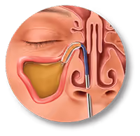 Balloon Sinuplasty Procedure Dilate