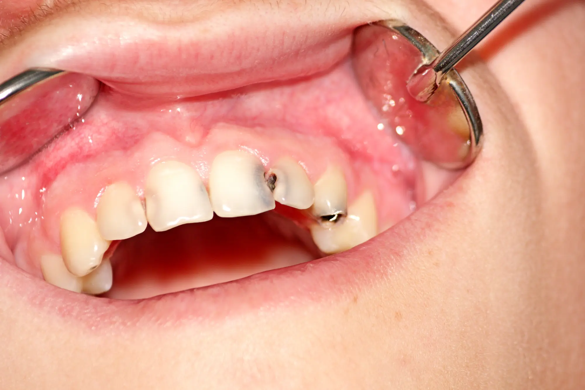Signs of a Cavity You Shouldn’t Ignore