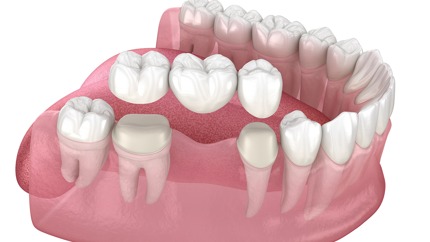 Dental Bridge Prep
