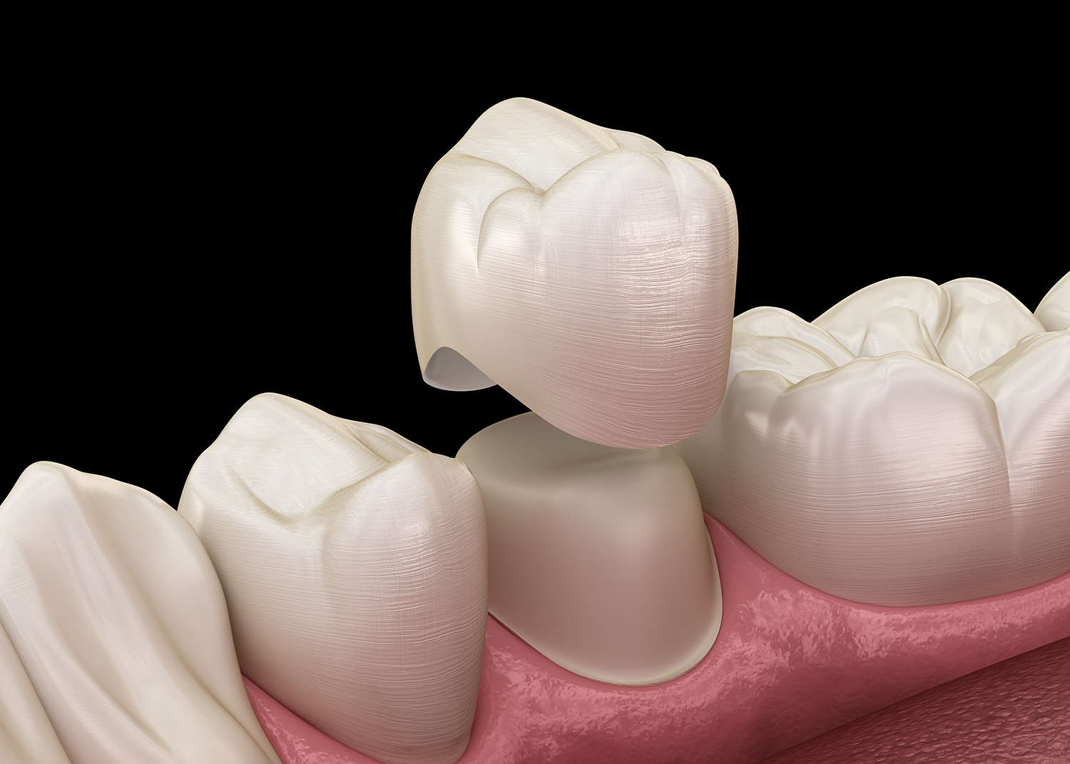 Dental crown