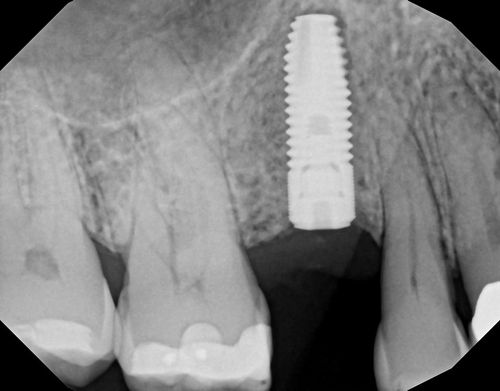 Maxillary Dental Implants