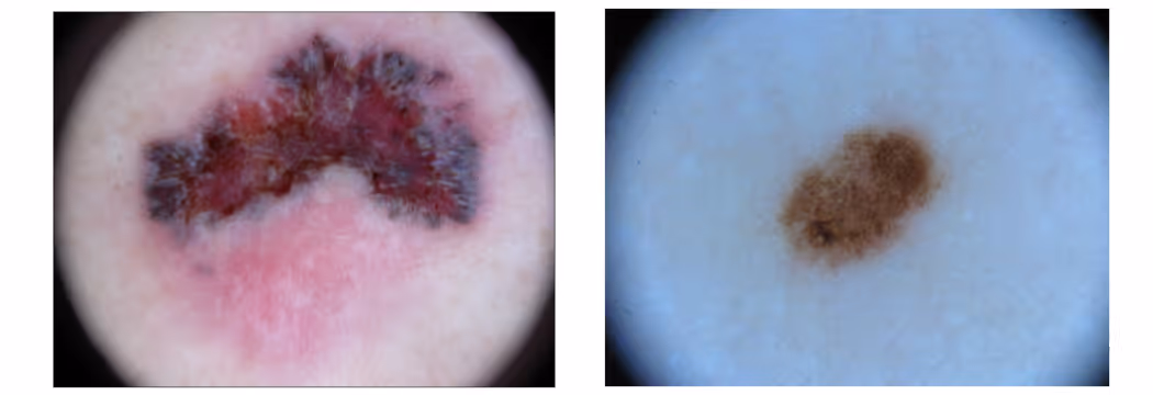 Two pictures of two different stages of melanoma