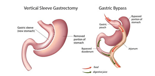 sleeve gastrectomy