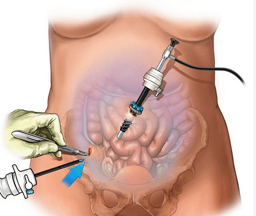 Laparoscopic Surgery Tauranga