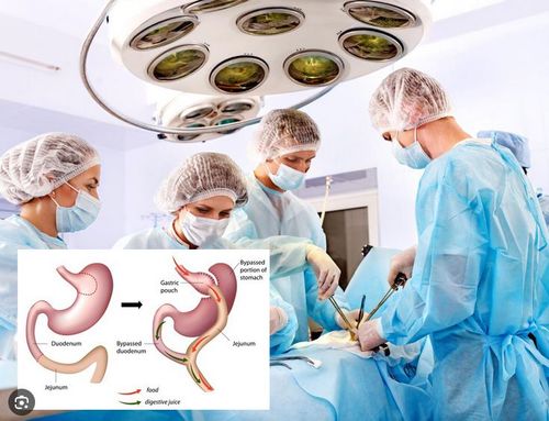 Bariatric surgery
