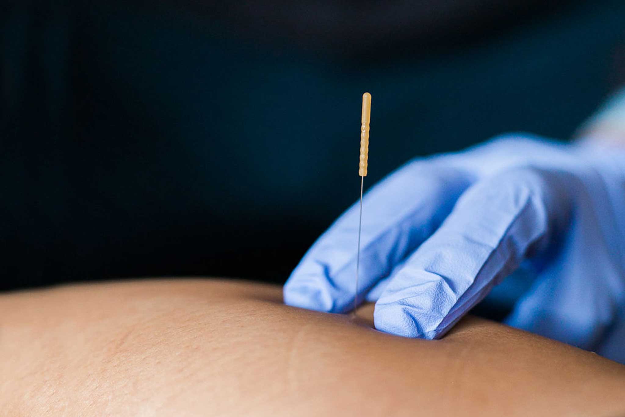 Undefeeted Podiatry — dry needling trigger point release