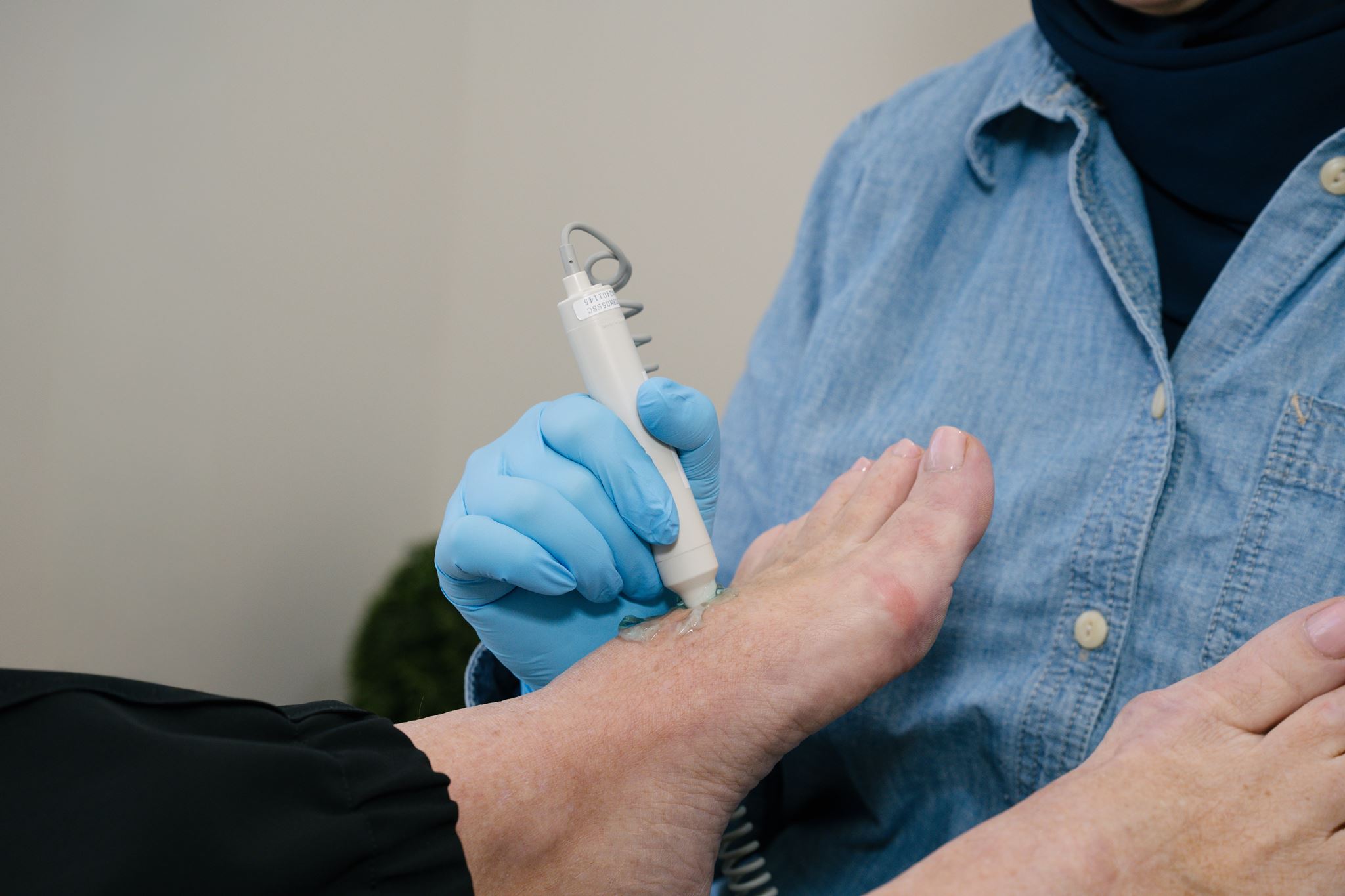 Swift wart treatment at Undefeeted Podiatry