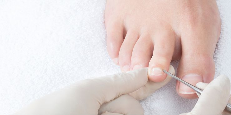 Podiatrist applying Onyfix brace