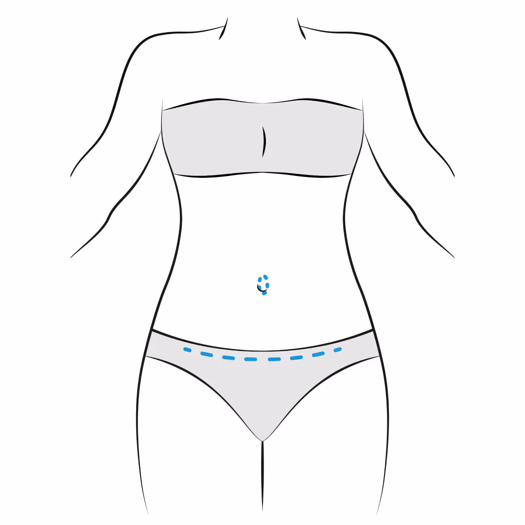Who Is a Good Candidate for a Tummy Tuck?