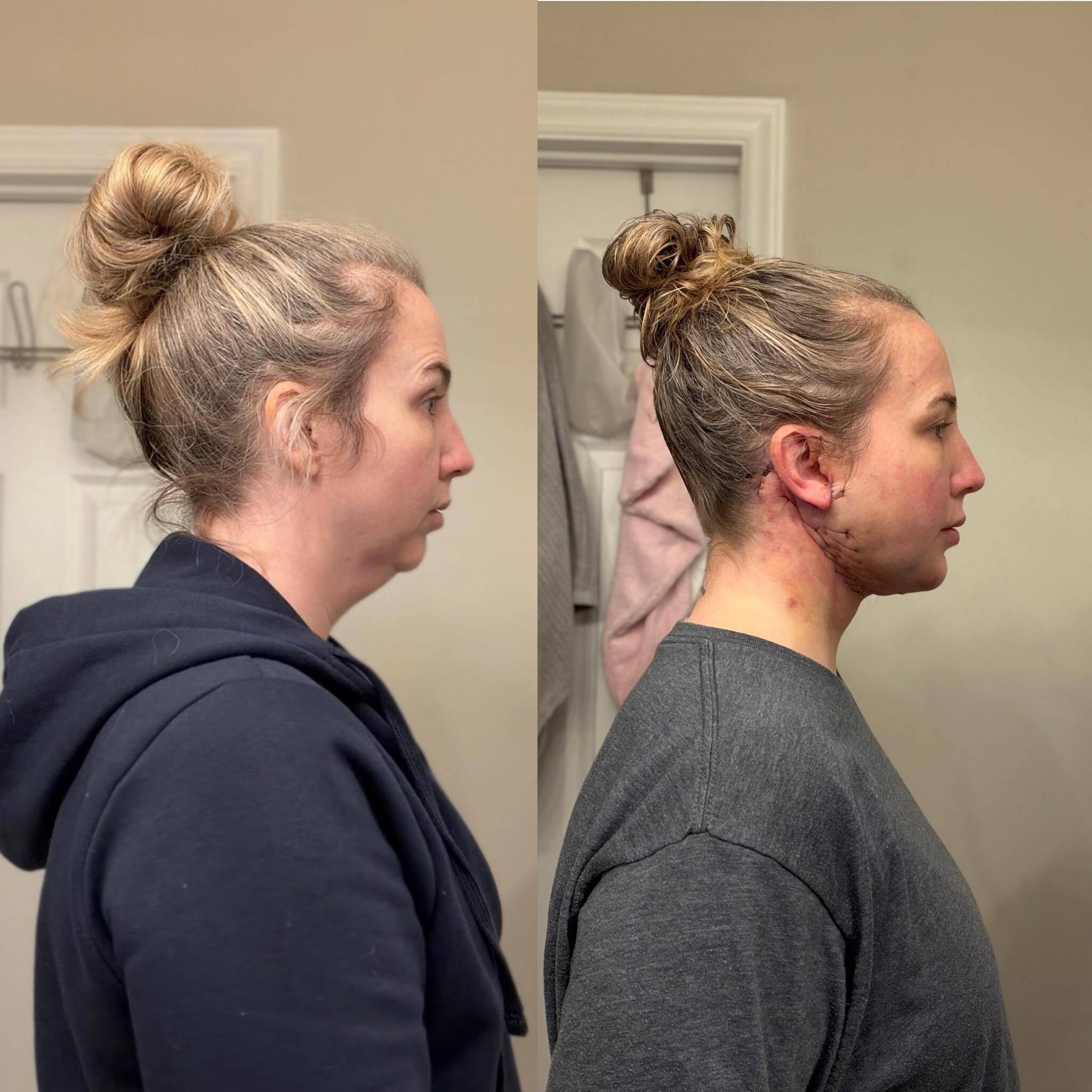 24 hour post-op Lower Facelift and Chin Implant before and after photo Dr. Aspinder Singh, Amelia Aesthetics, Raleigh, NC