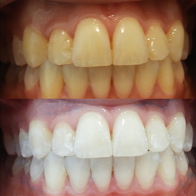 3. Blanqueamiento Dental