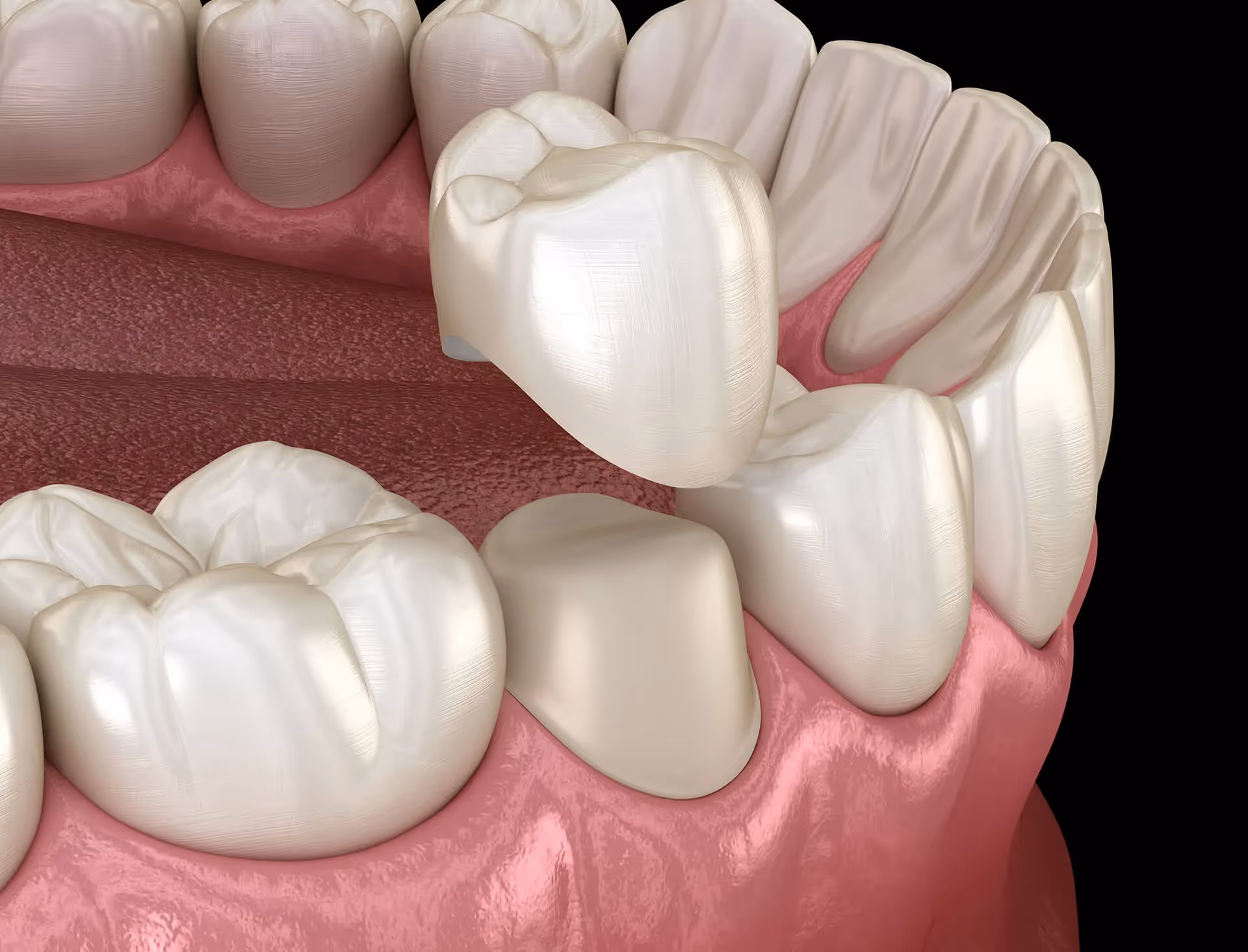 What are Dental Crowns?