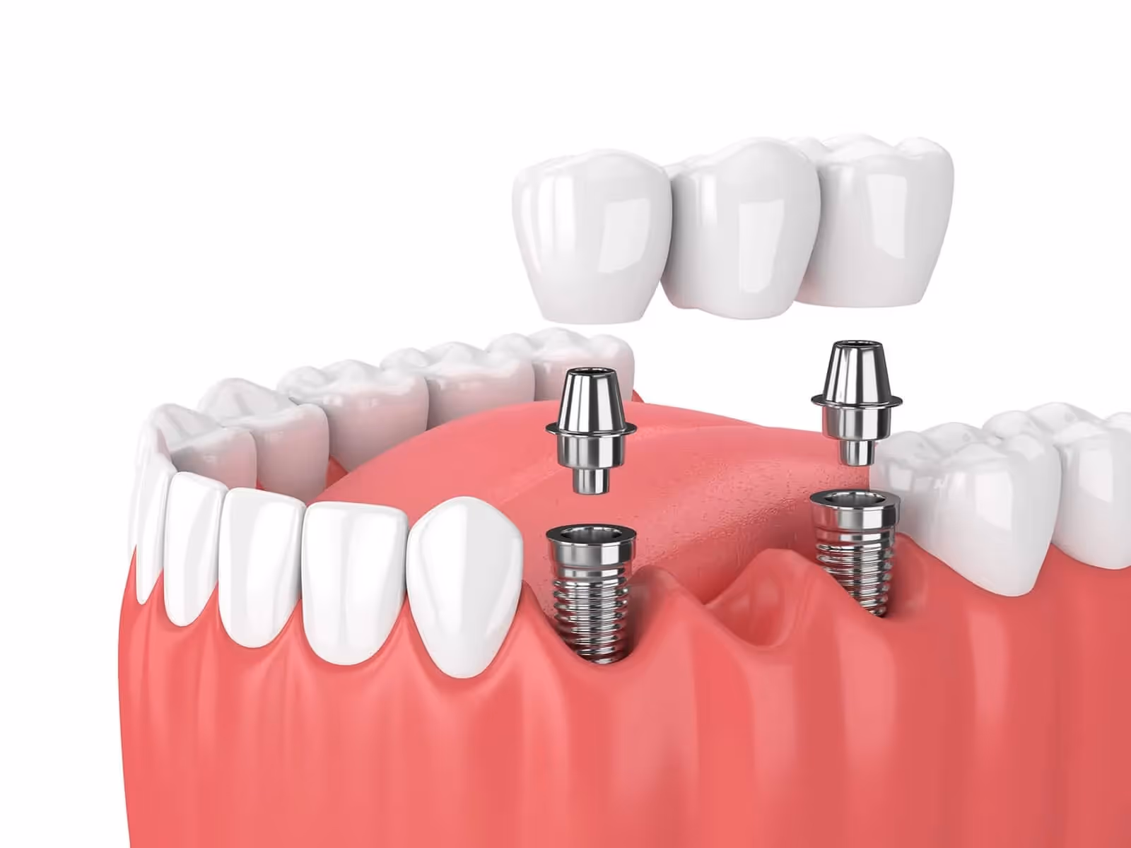 Dental Implants Restoration Denver CO