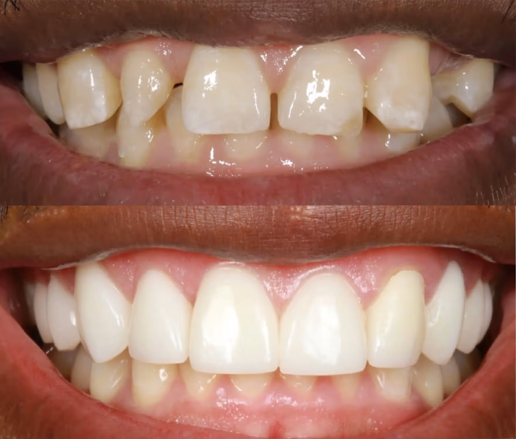Porcelain Veneers Denver