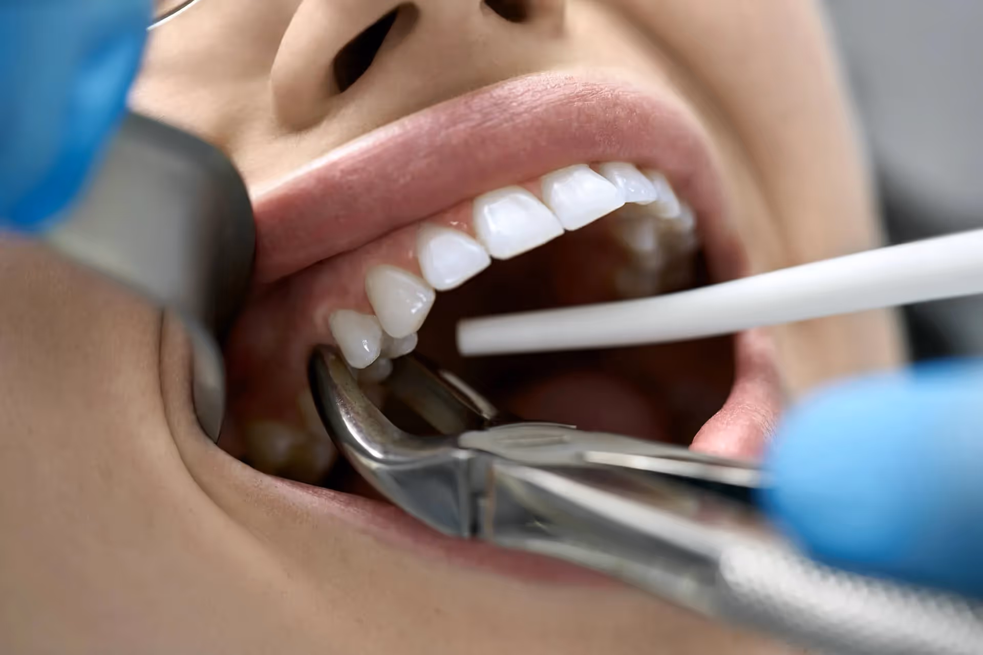 Abscessed Tooth