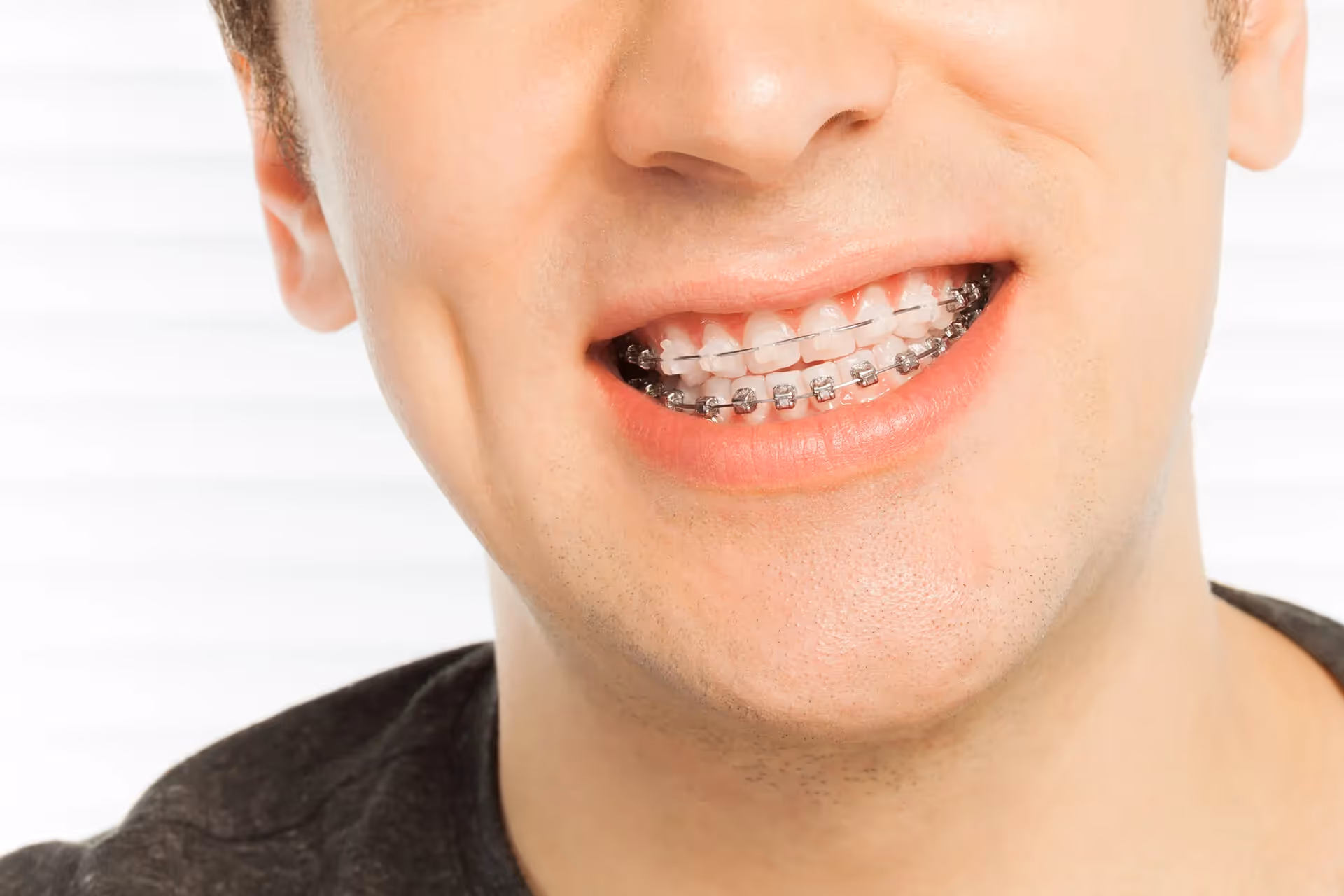 Braces (Orthodontia)