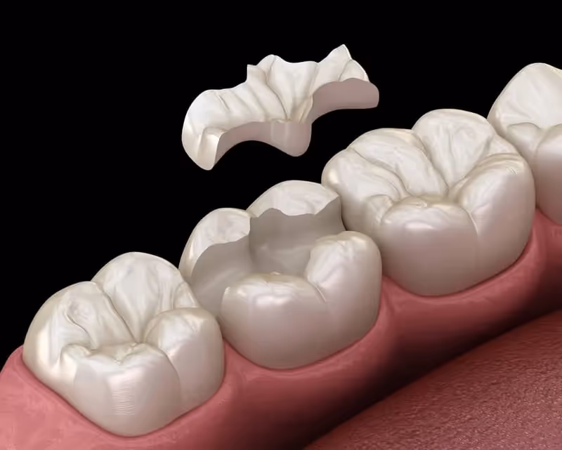 Enhancing Your Smile with Inlays and Onlays