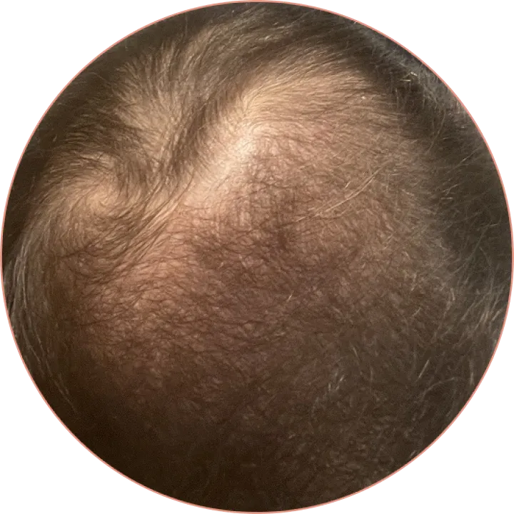 Crown of male's head after six months of using Pilot's hair loss treatment
