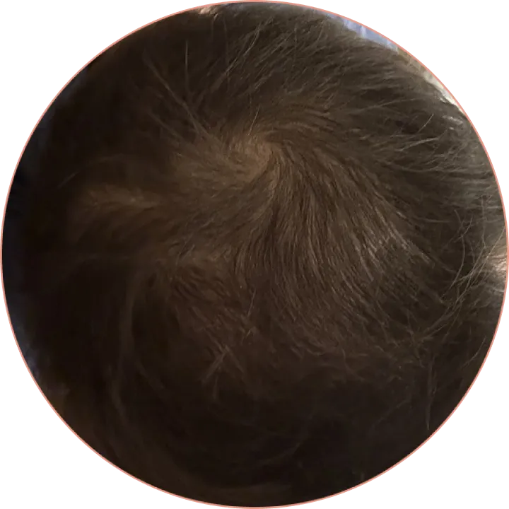 Crown of male's head after nine months of using Pilot's hair loss treatment
