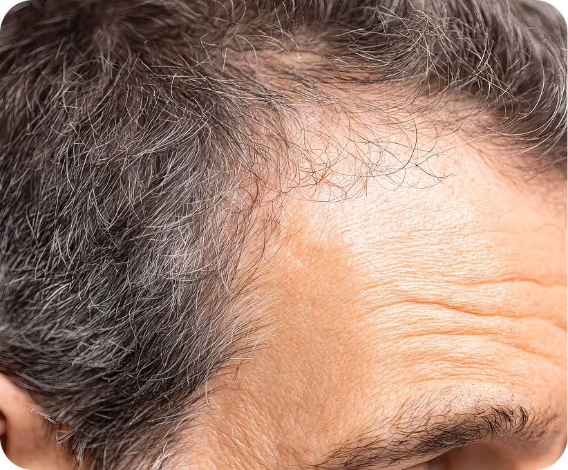 Man with thinning hair