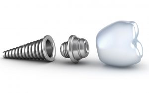 where are good dental implants orlando fl?