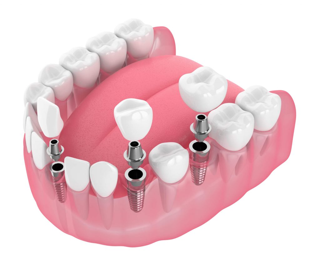 Where can I find teeth in a day Orlando?