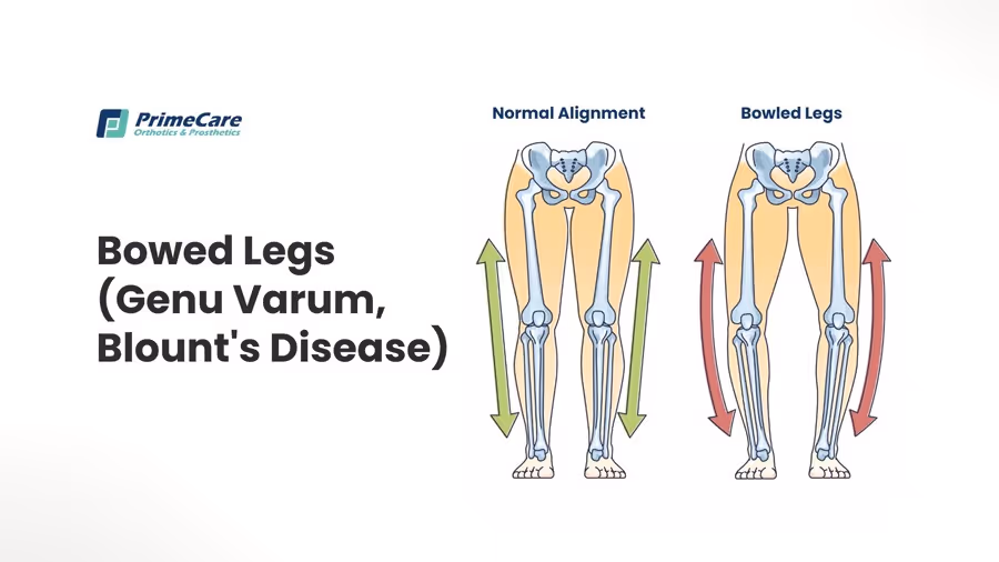 Bowed Legs (Genu Varum, Blount's Disease)