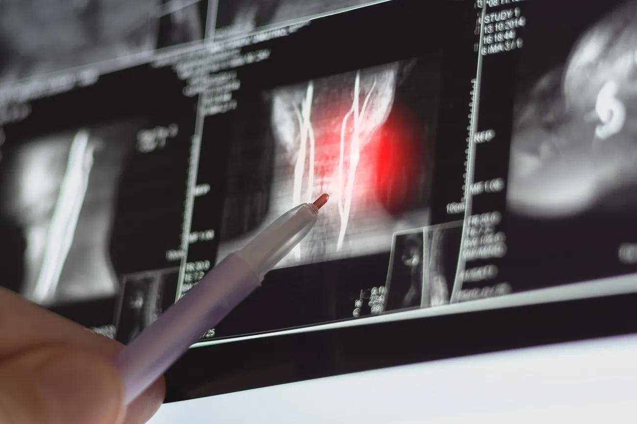 Understanding Cervical Spondylosis