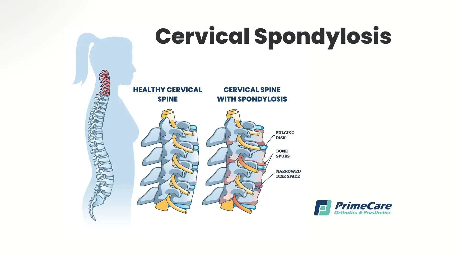Cervical Spondylosis
